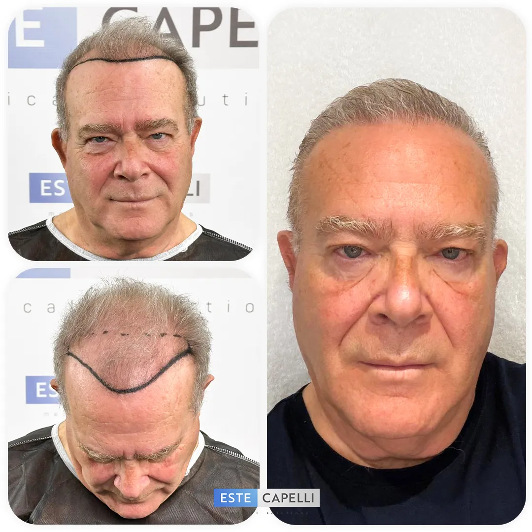 Before and after result