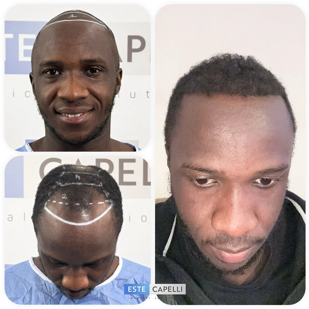 Before and after result