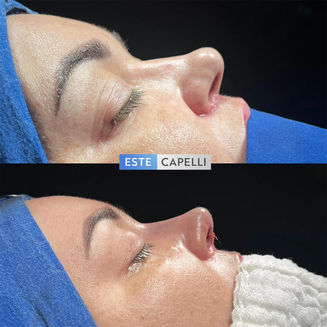 Before and after result