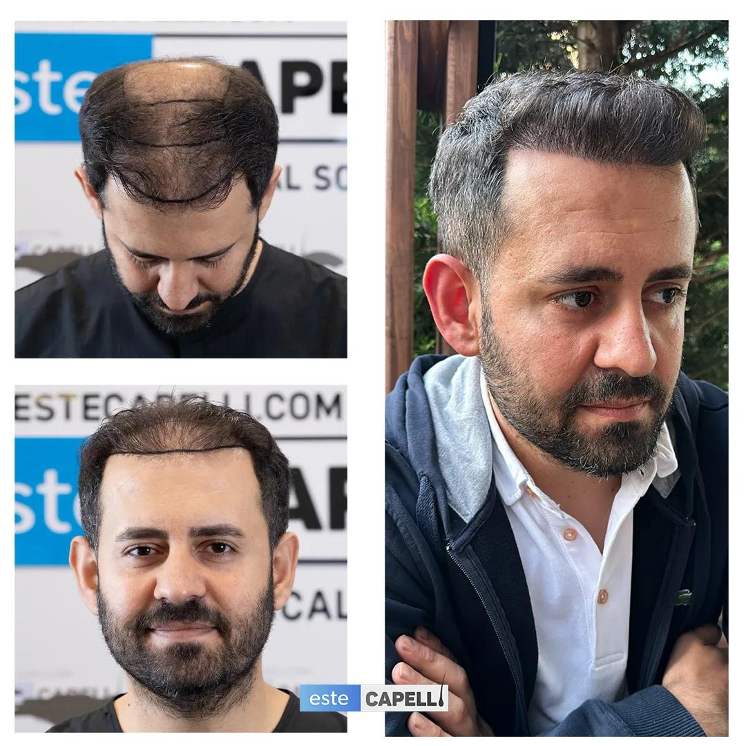 Before and after result