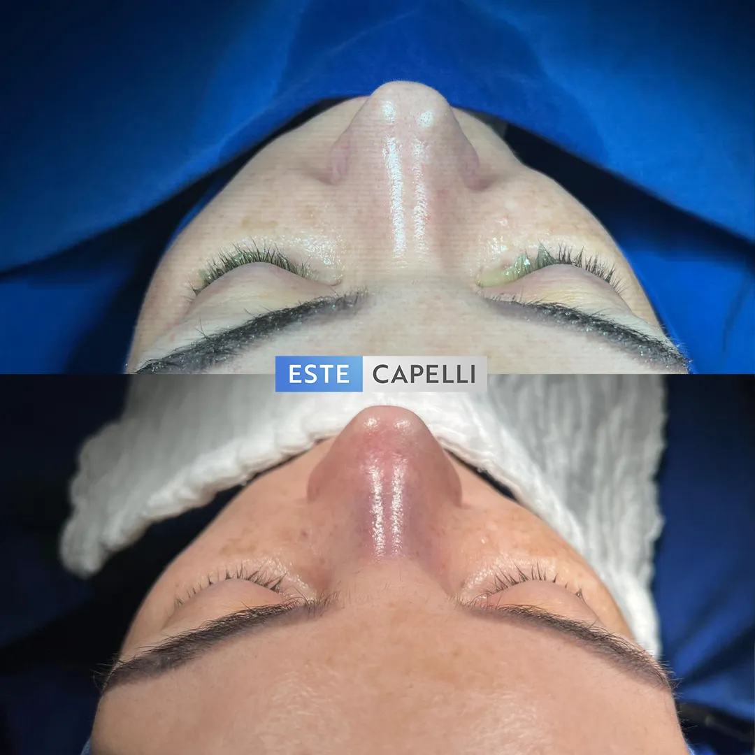 Before and after result