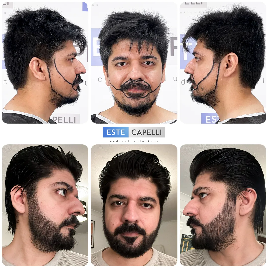 Before and after result