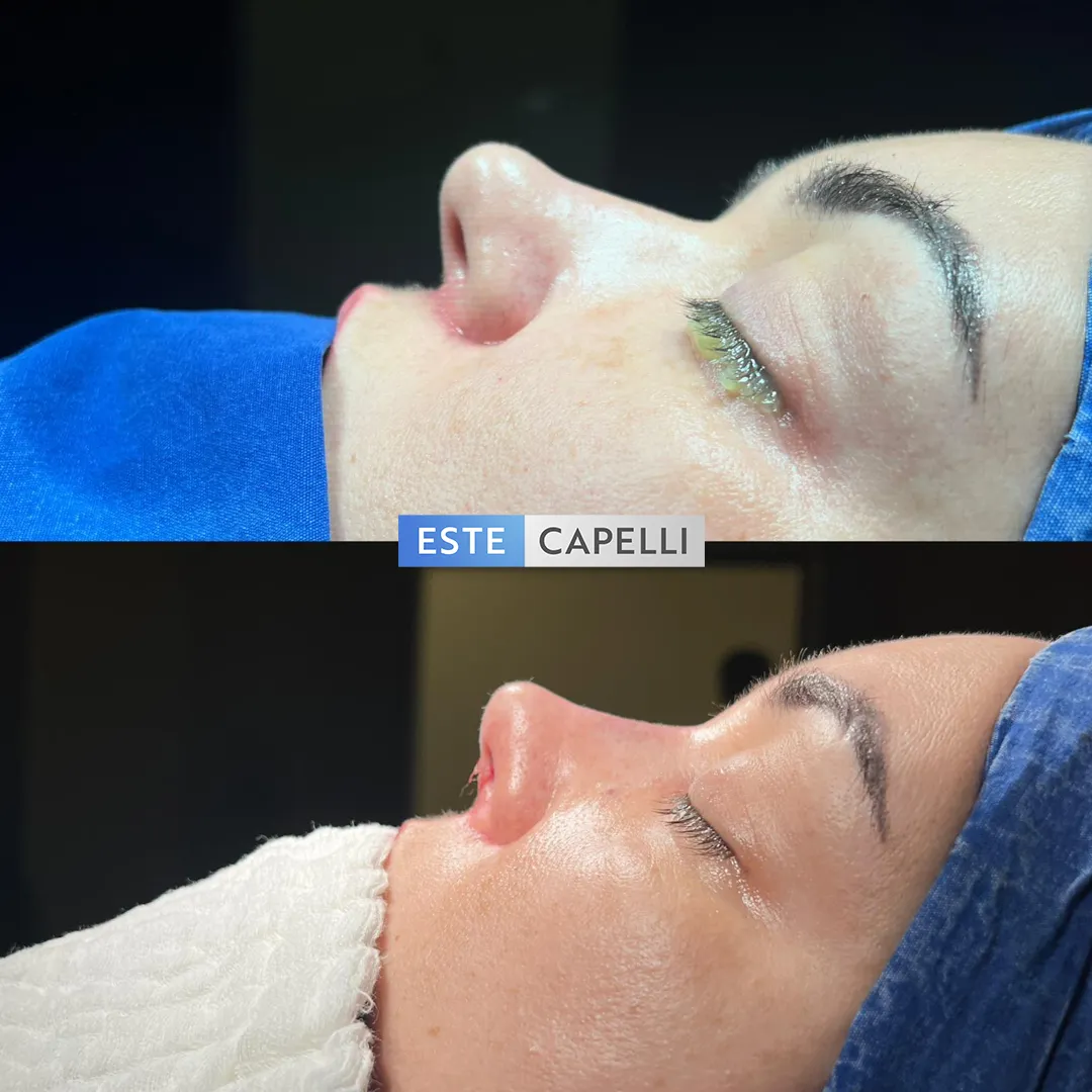 Before and after result