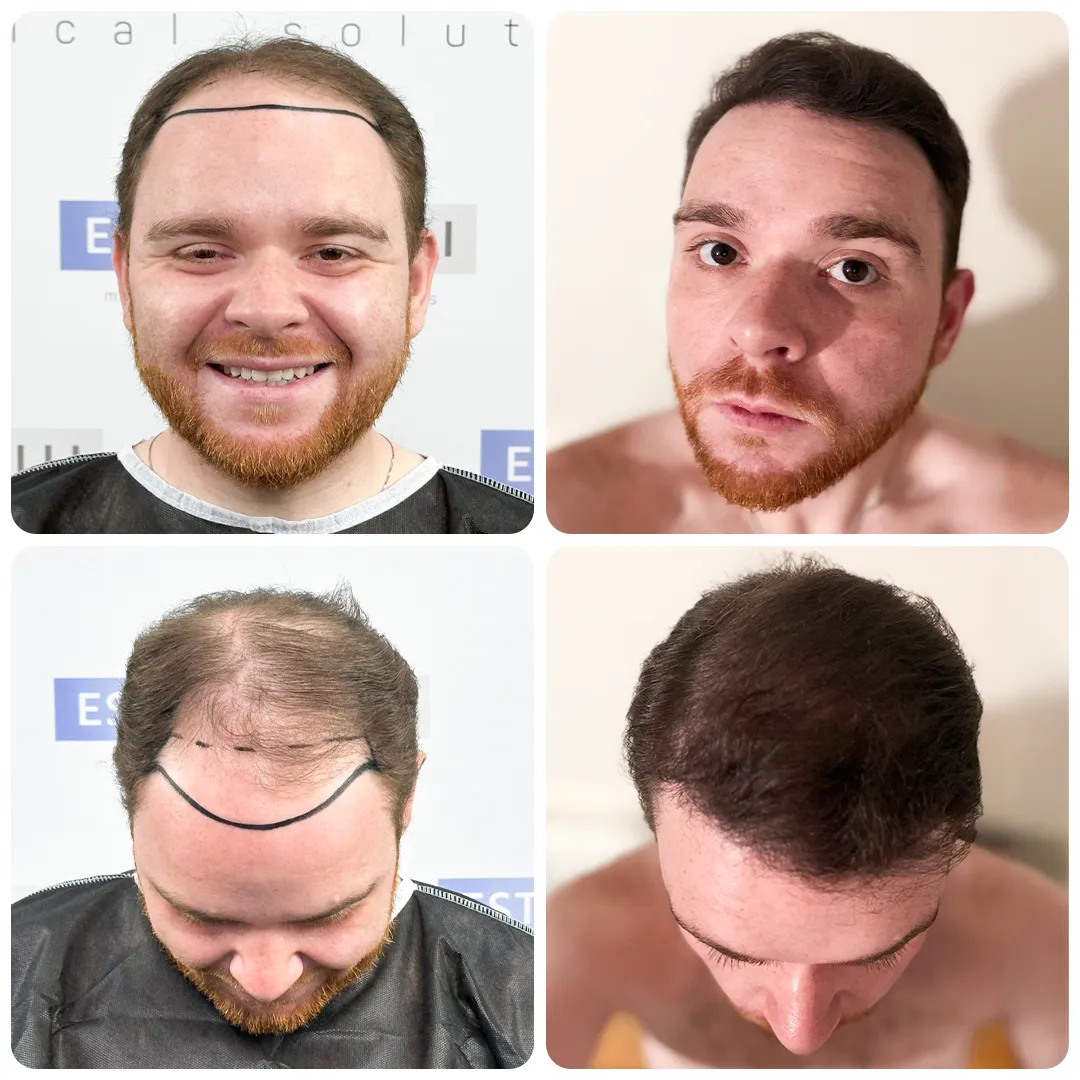 Before and after result