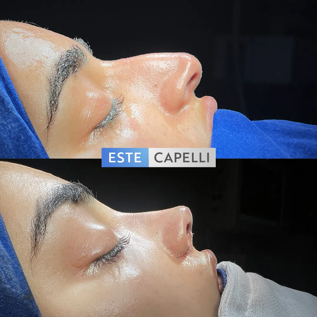 Before and after result