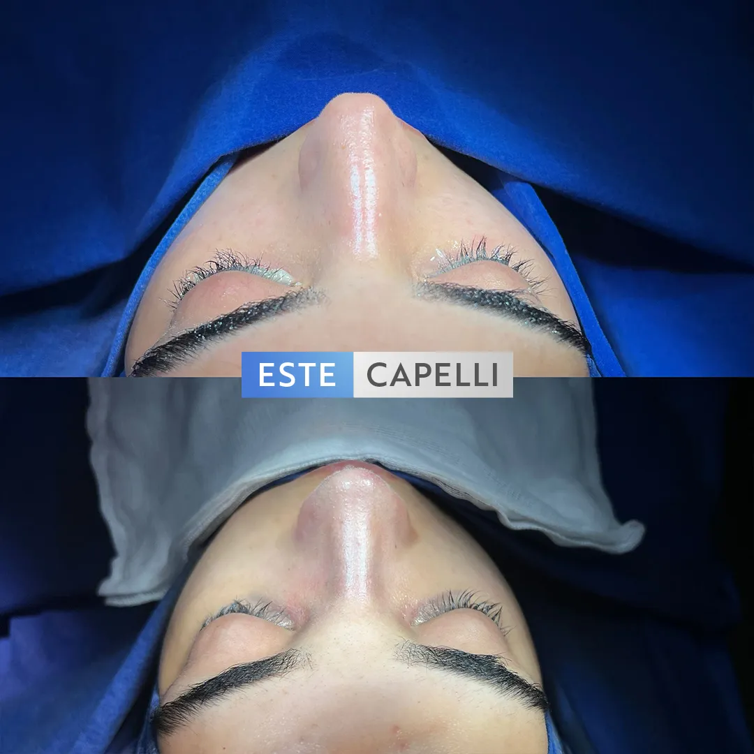 Before and after result