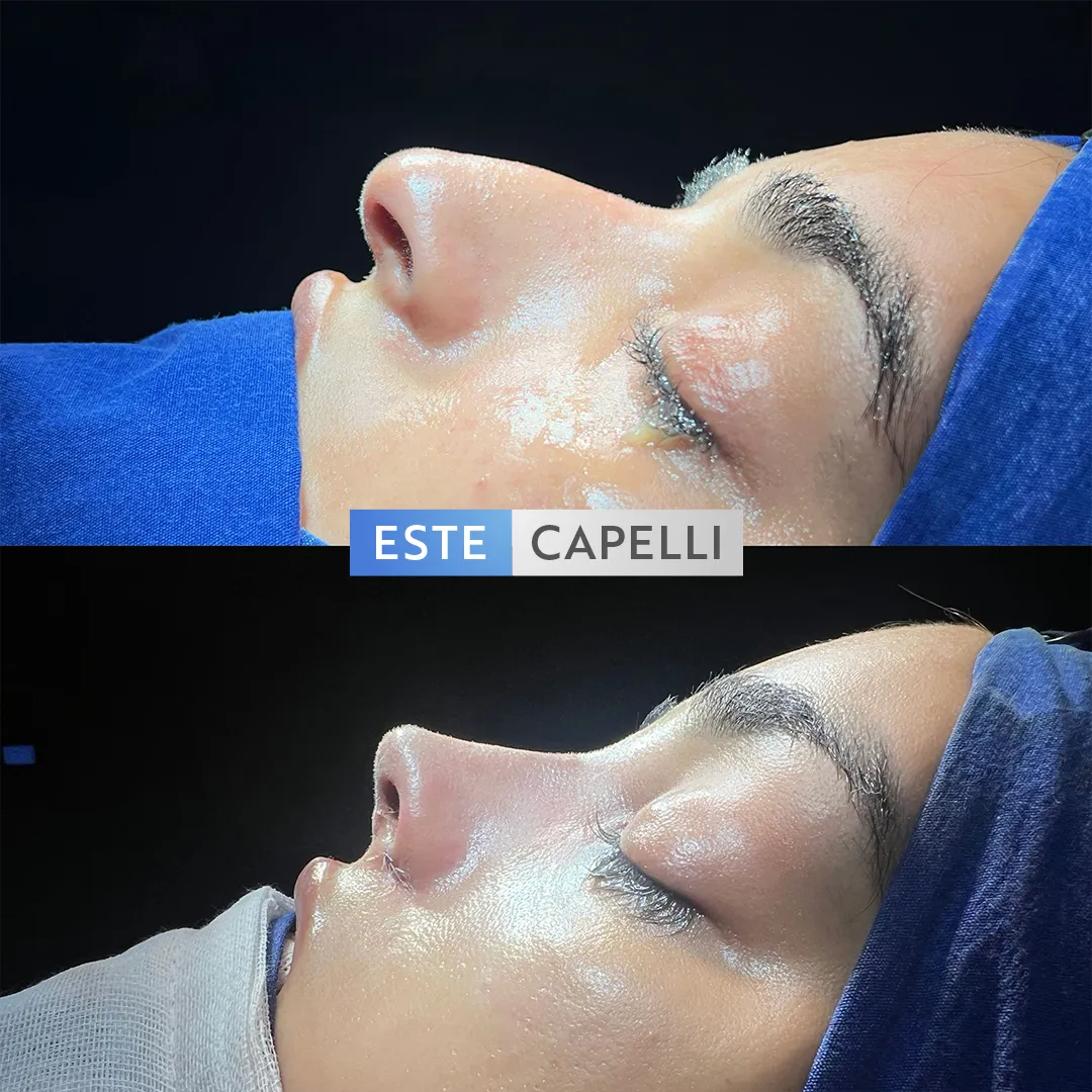 Before and after result