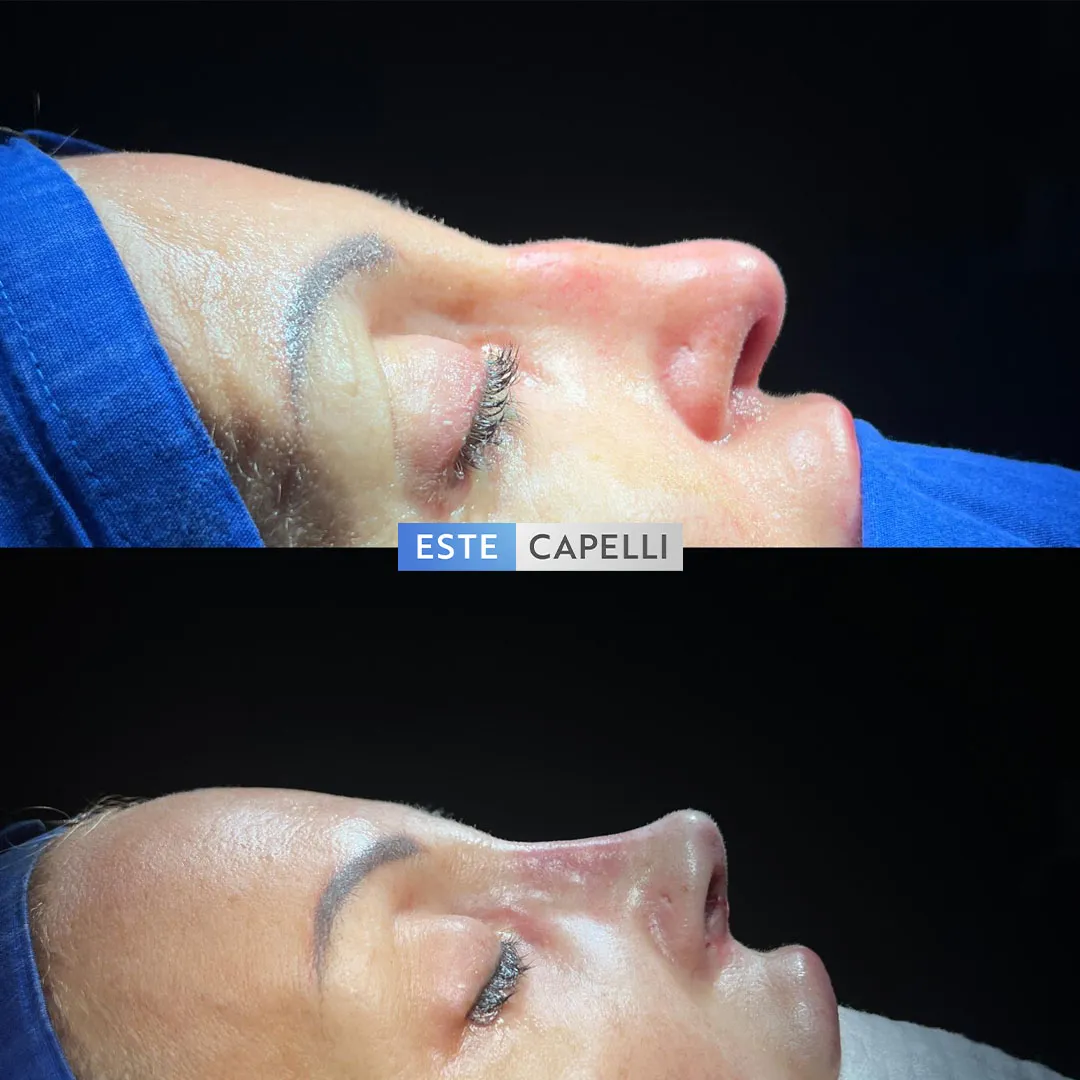 Before and after result