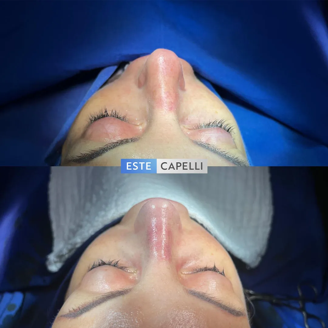 Before and after result