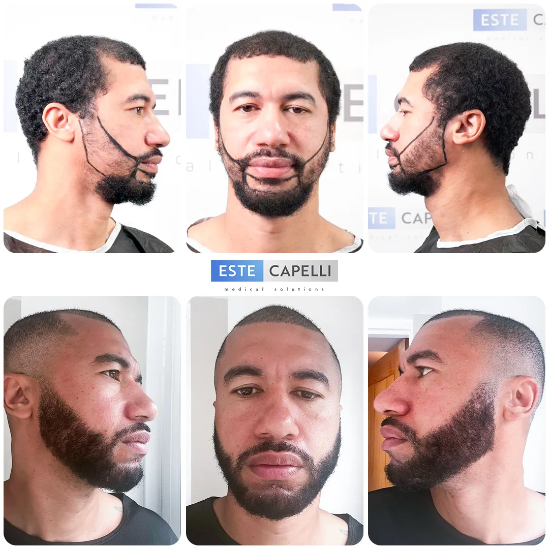 Before and after result