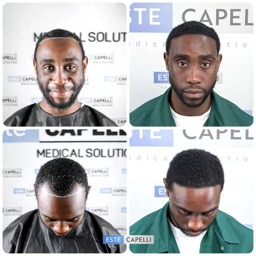 Before and after result