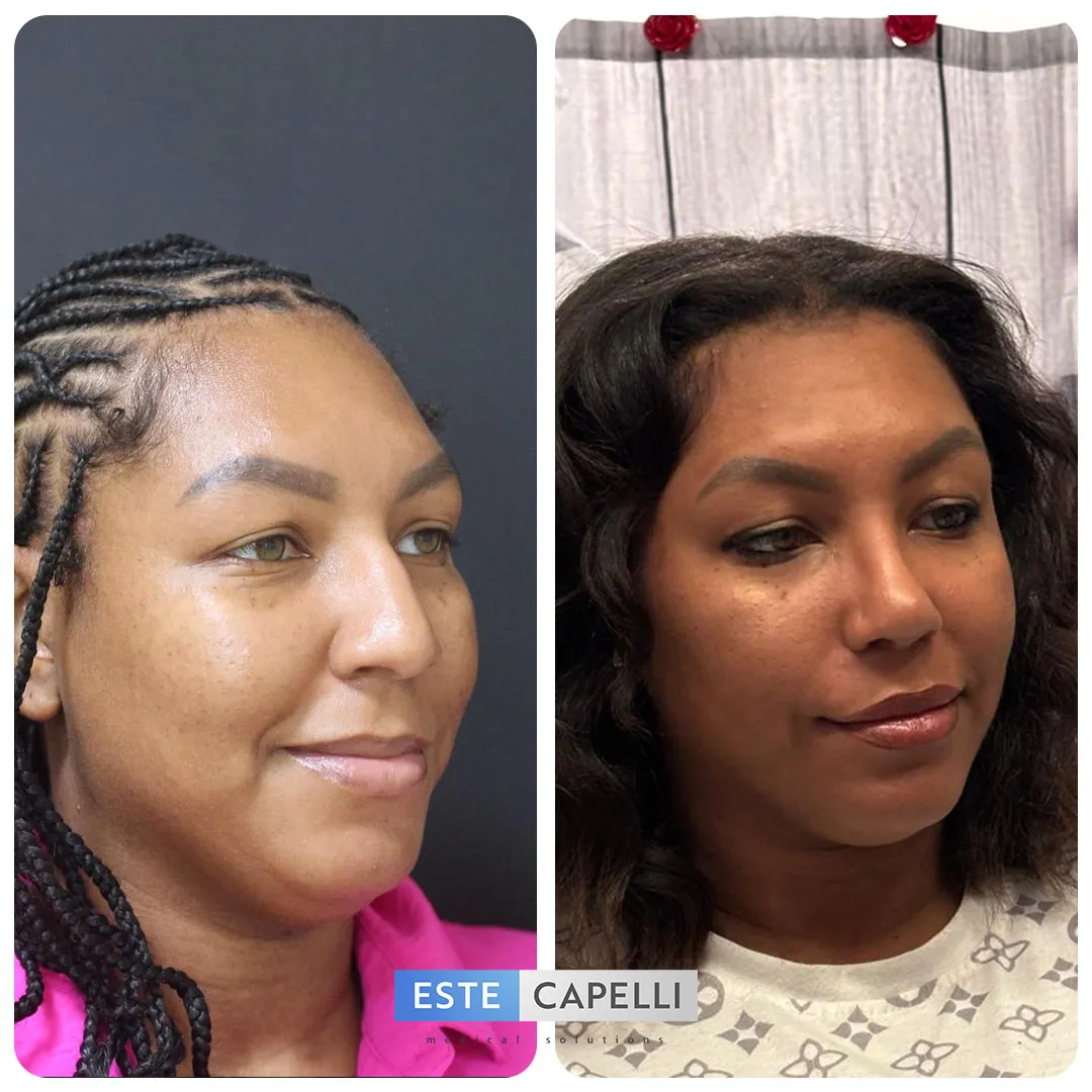 Before and after result