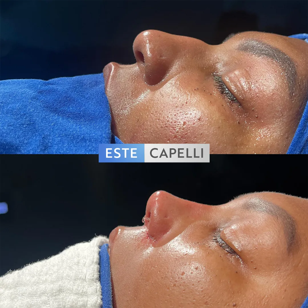 Before and after result
