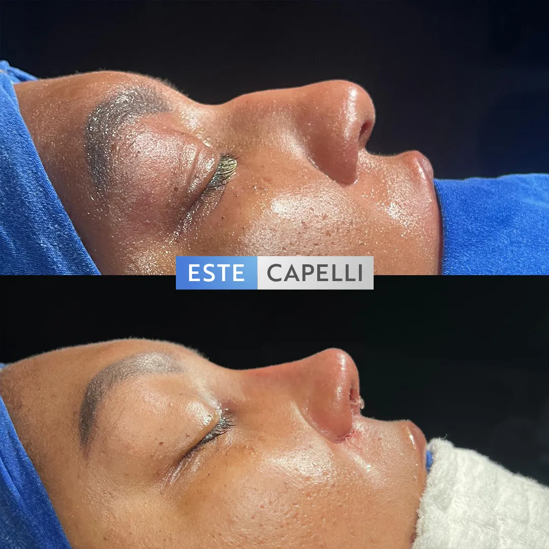 Before and after result