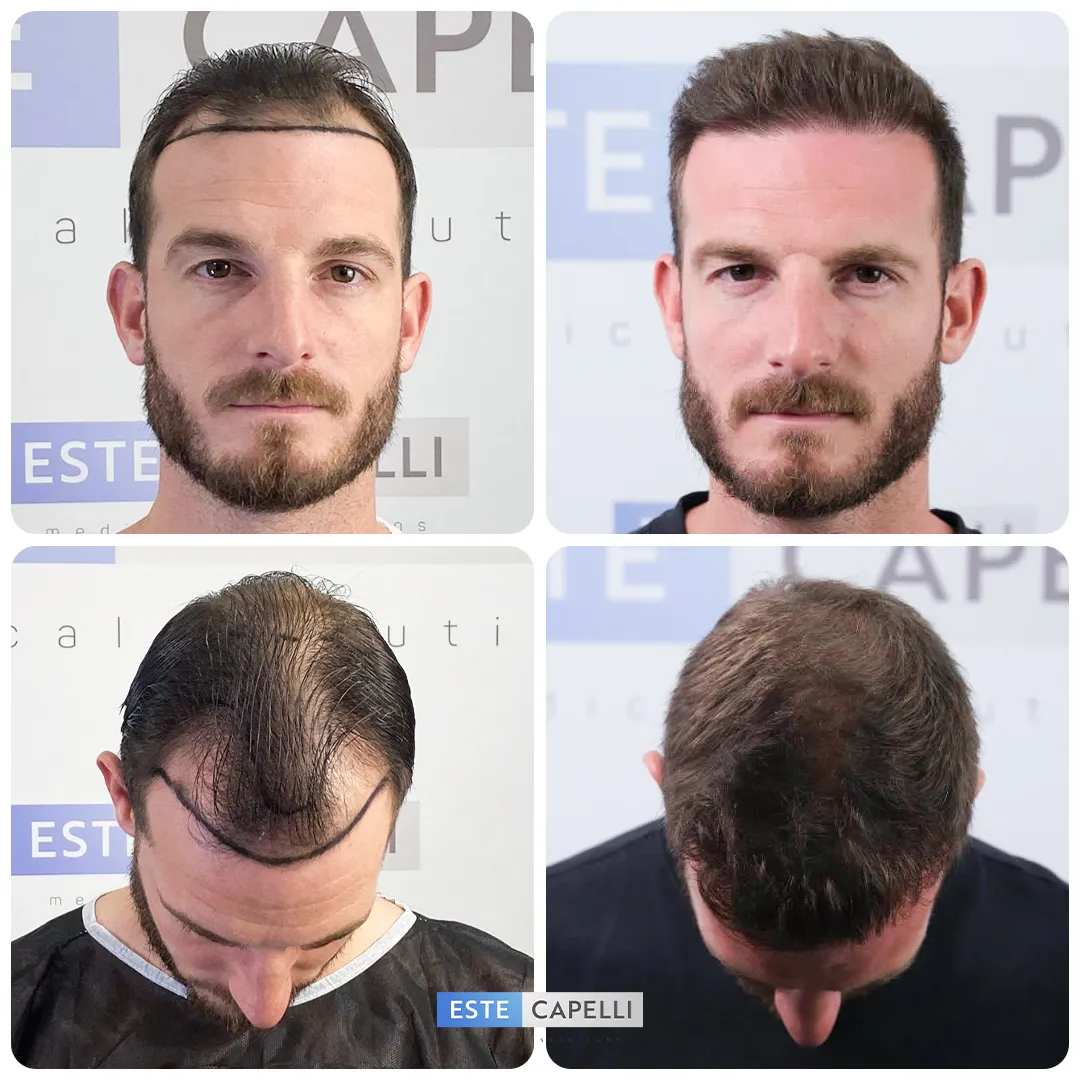 Before and after result