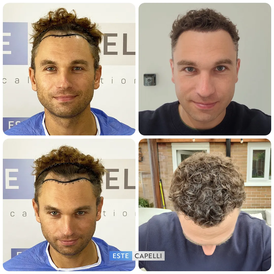 Before and after result