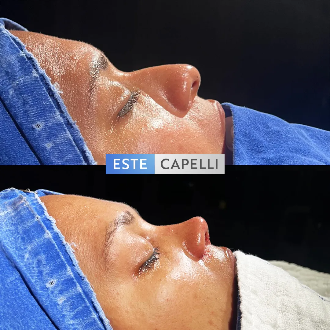 Before and after result