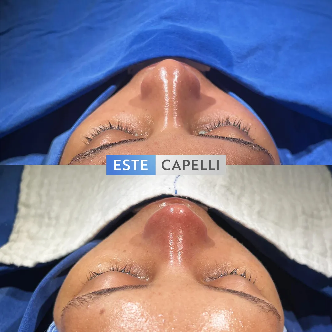 Before and after result