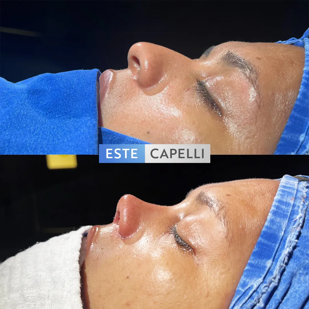 Before and after result