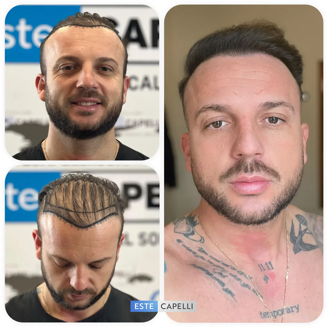 Before and after result