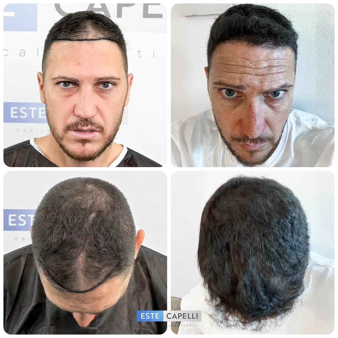 Before and after result