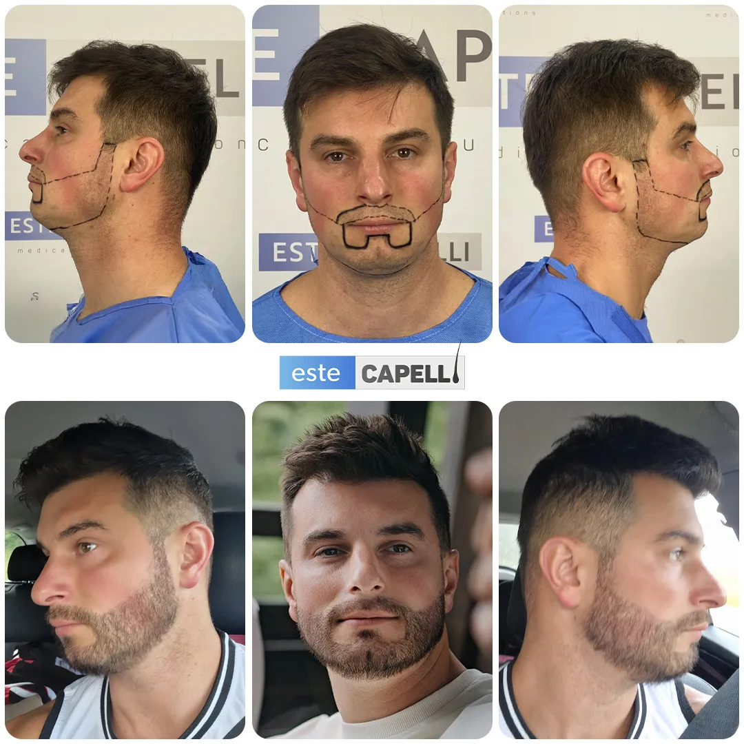 Before and after result