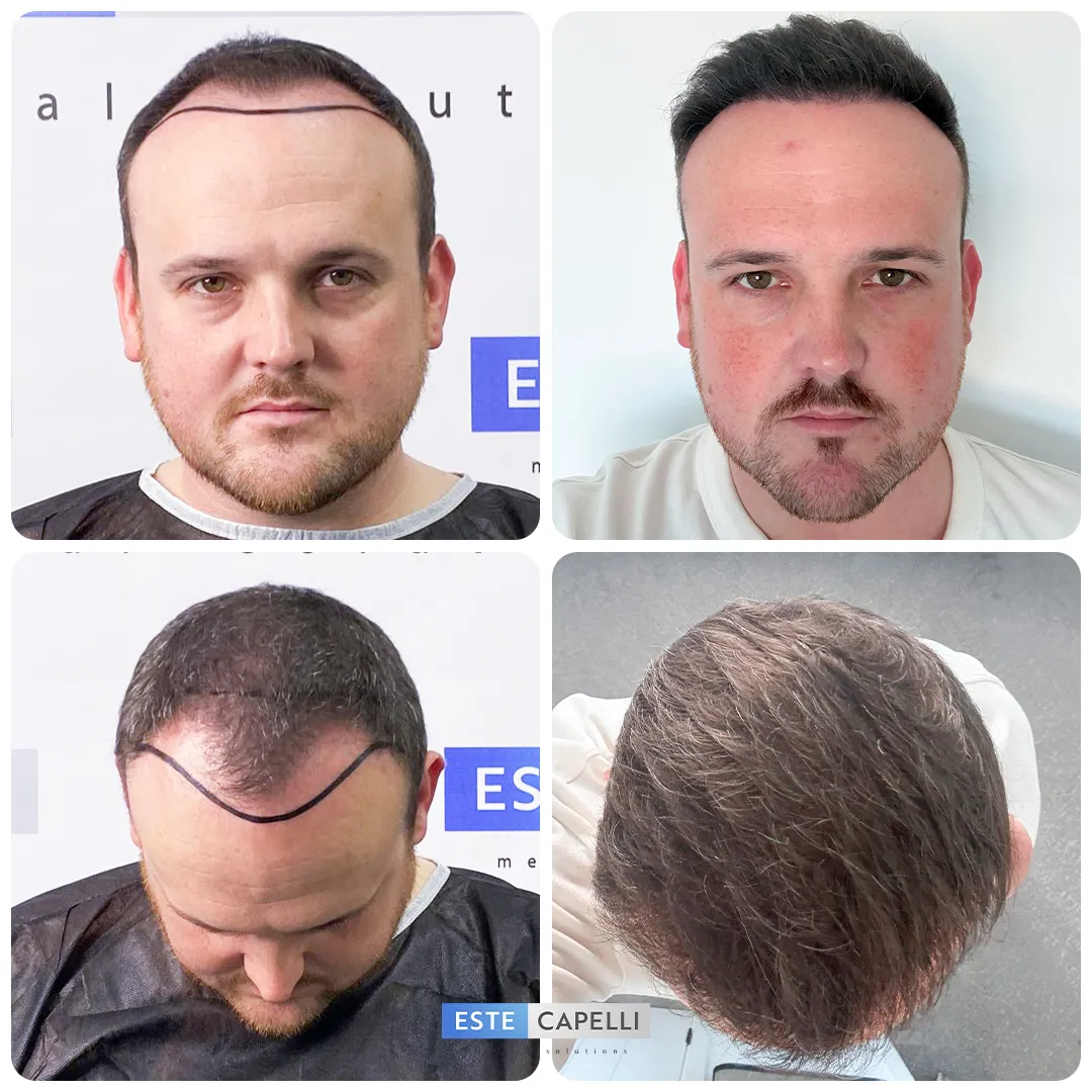 Before and after result