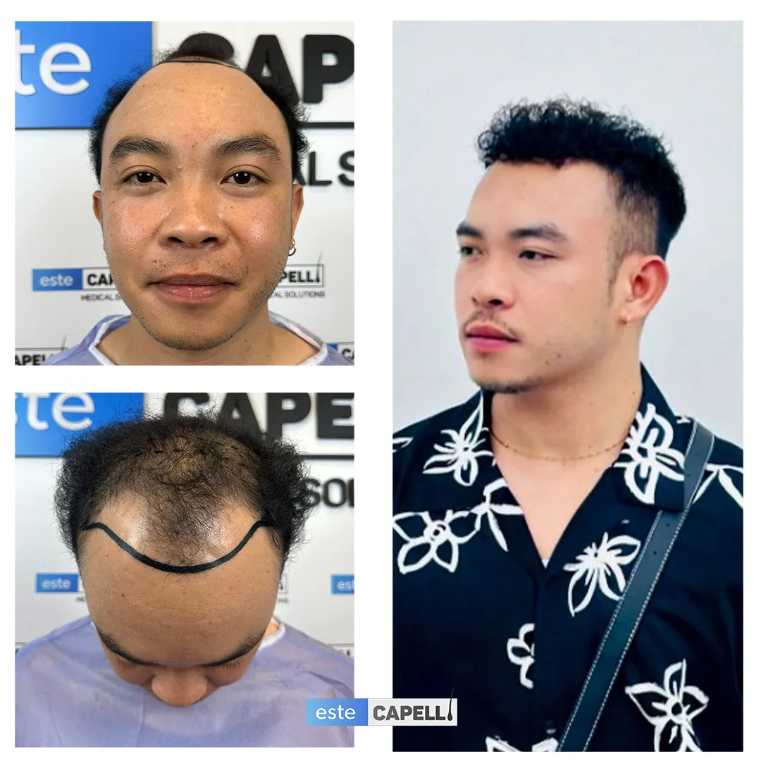 Before and after result