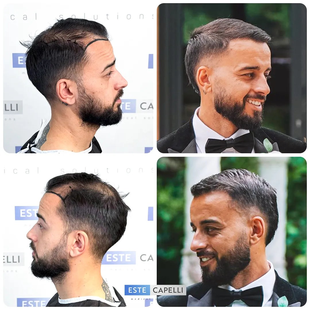Before and after result