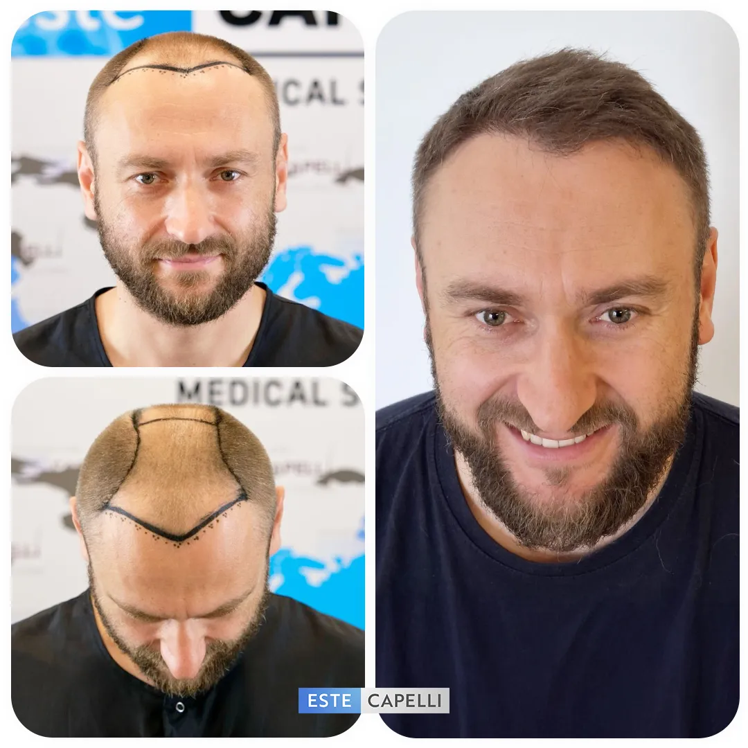 Before and after result