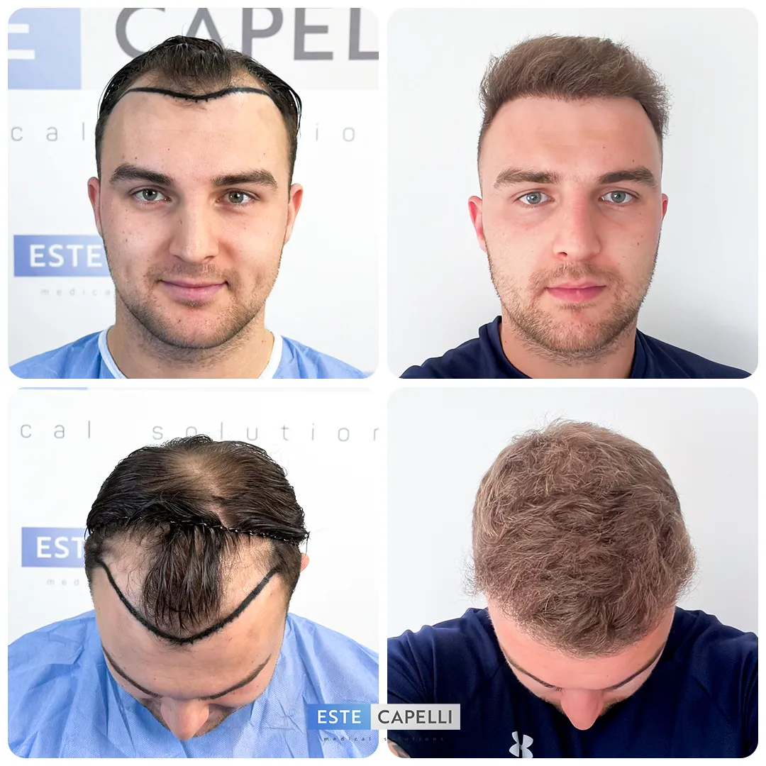 Before and after result