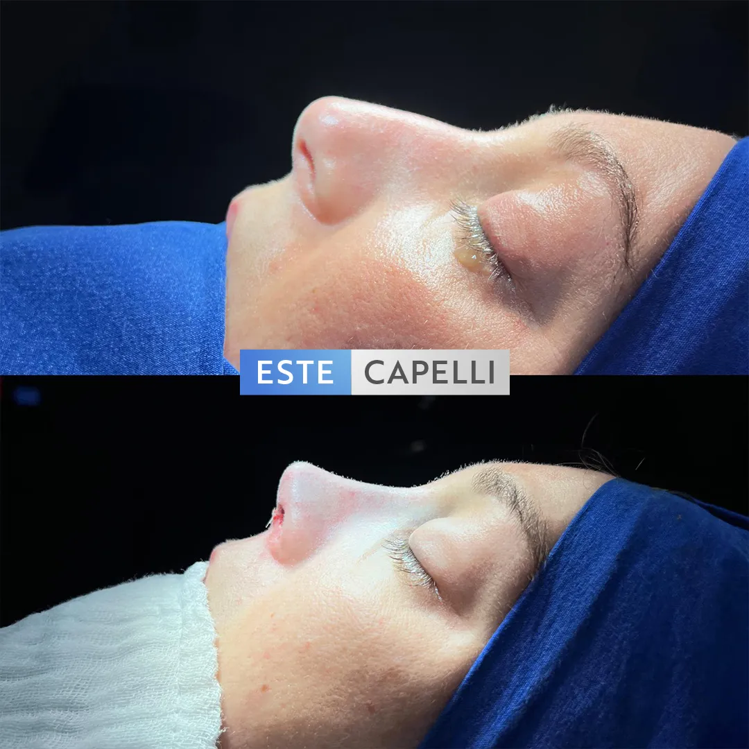 Before and after result
