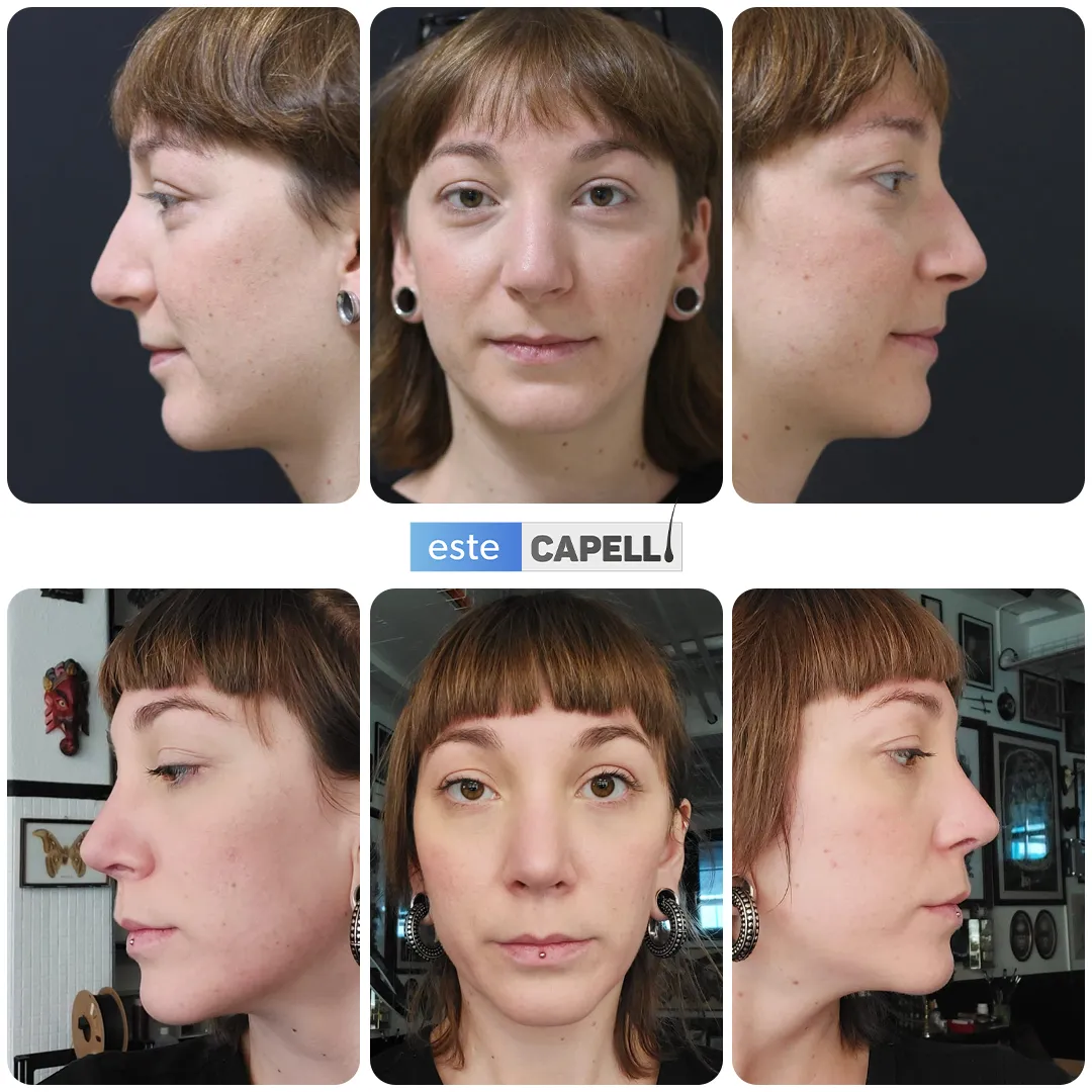 Before and after result