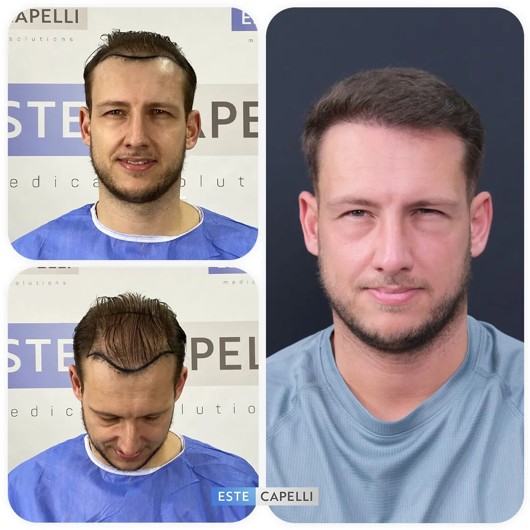 Before and after result
