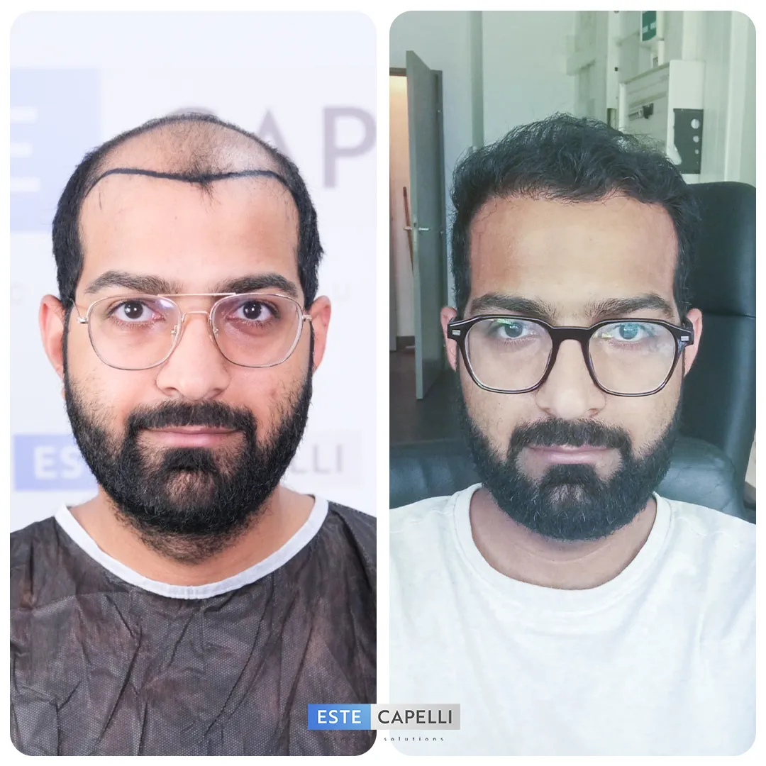 Before and after result
