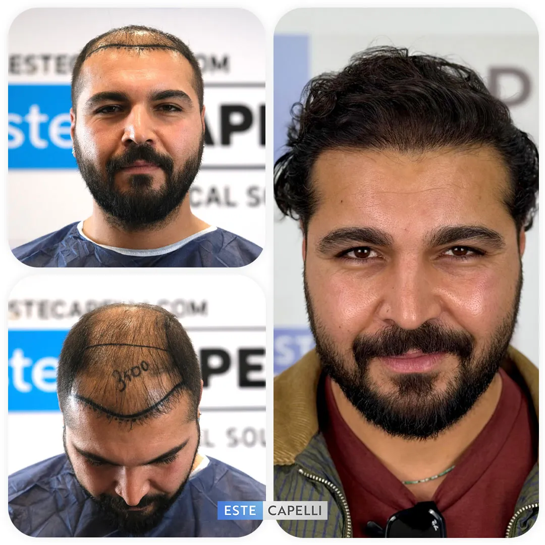 Before and after result