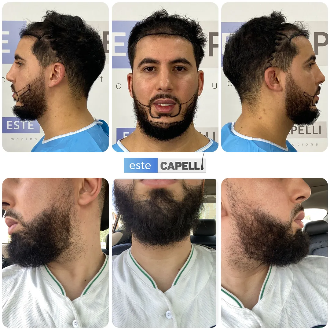 Before and after result