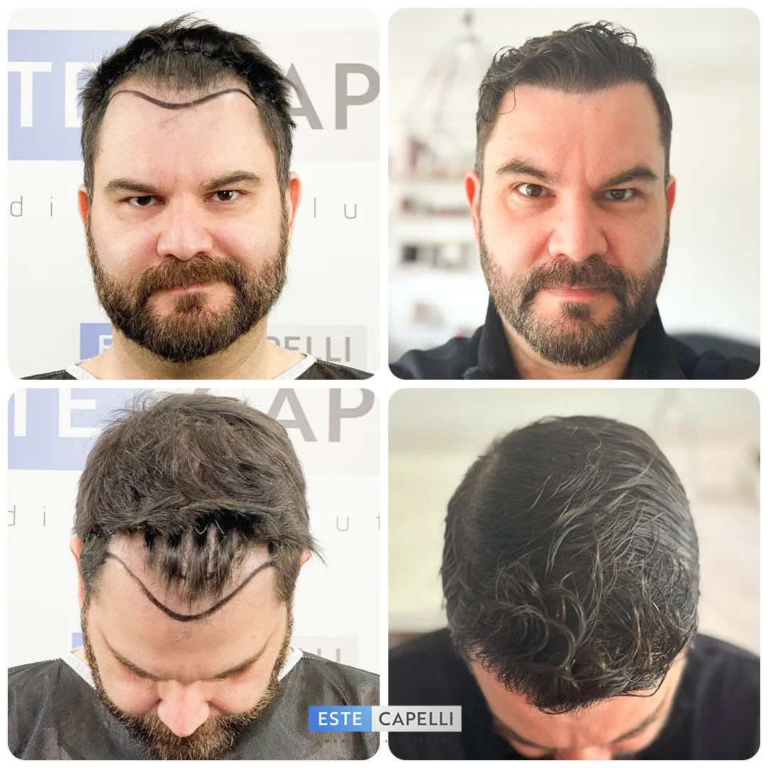 Before and after result