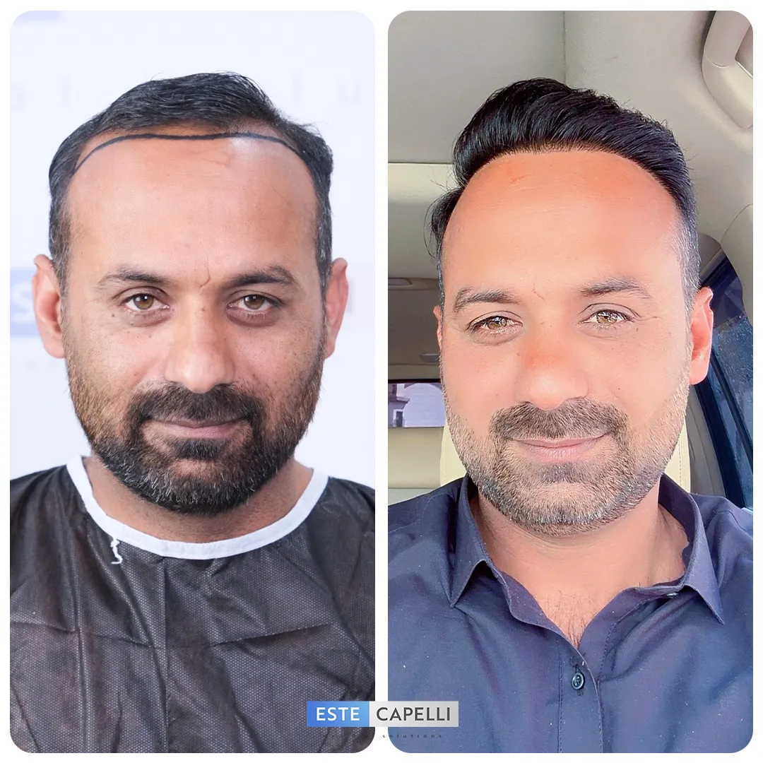 Before and after result