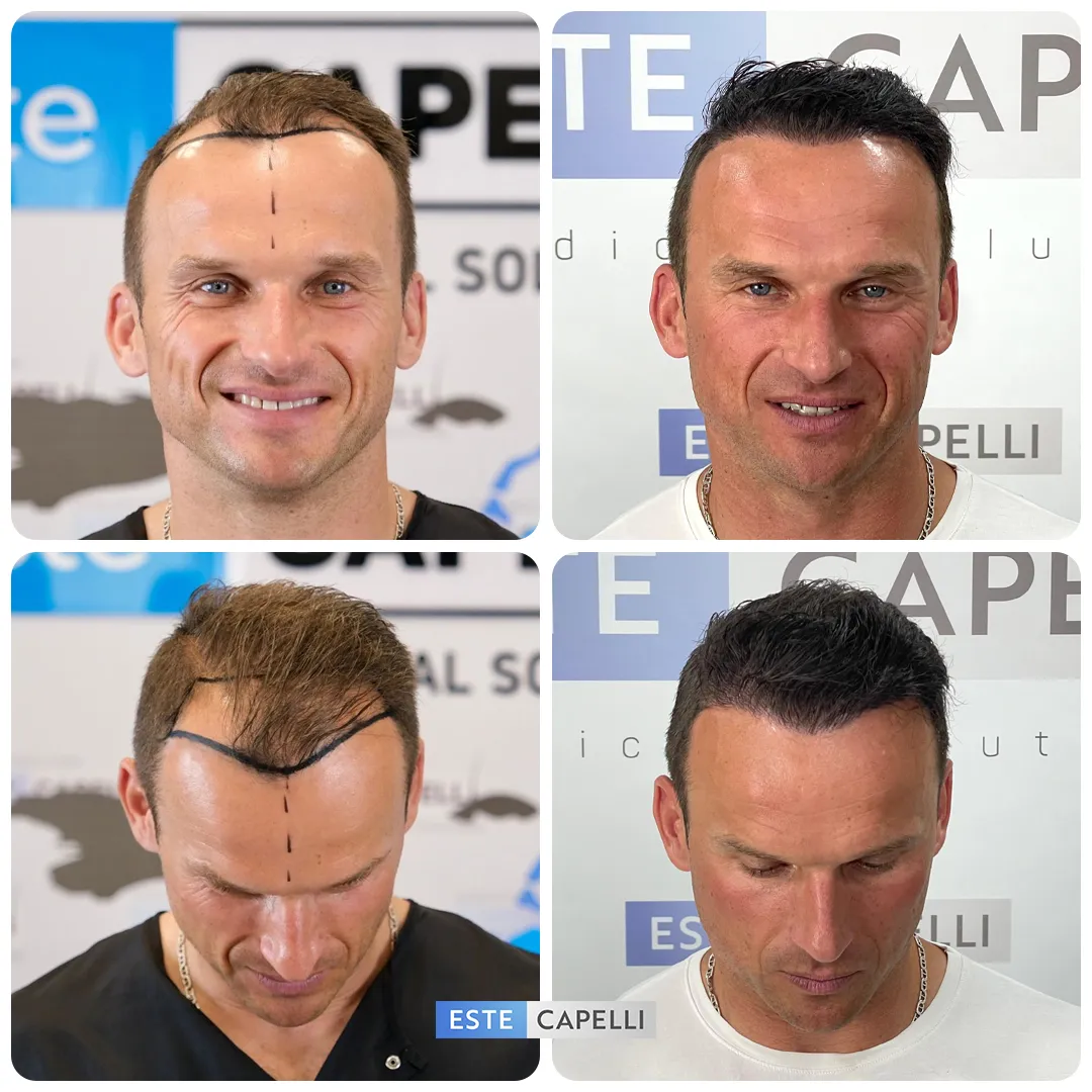 Before and after result