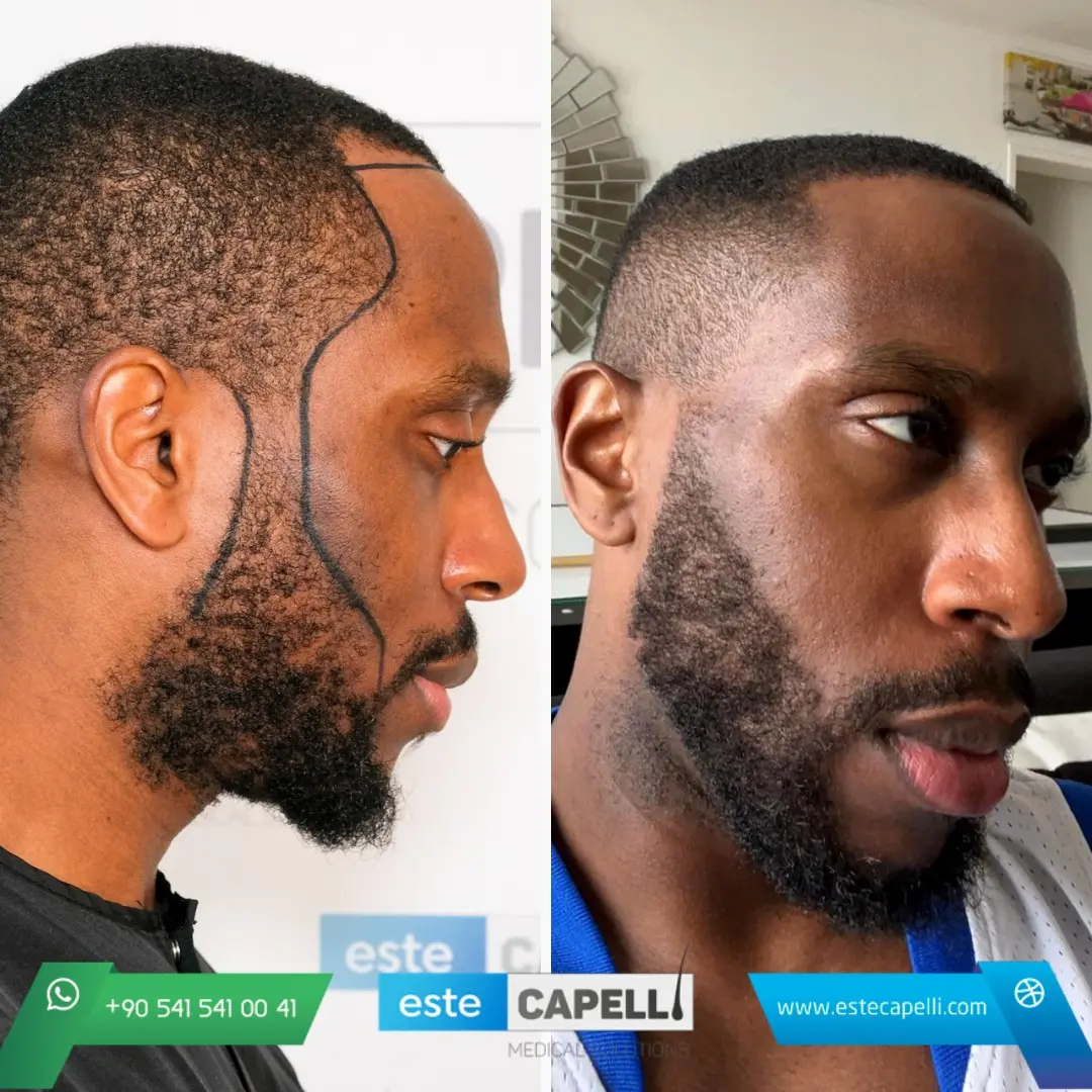 Before and after result
