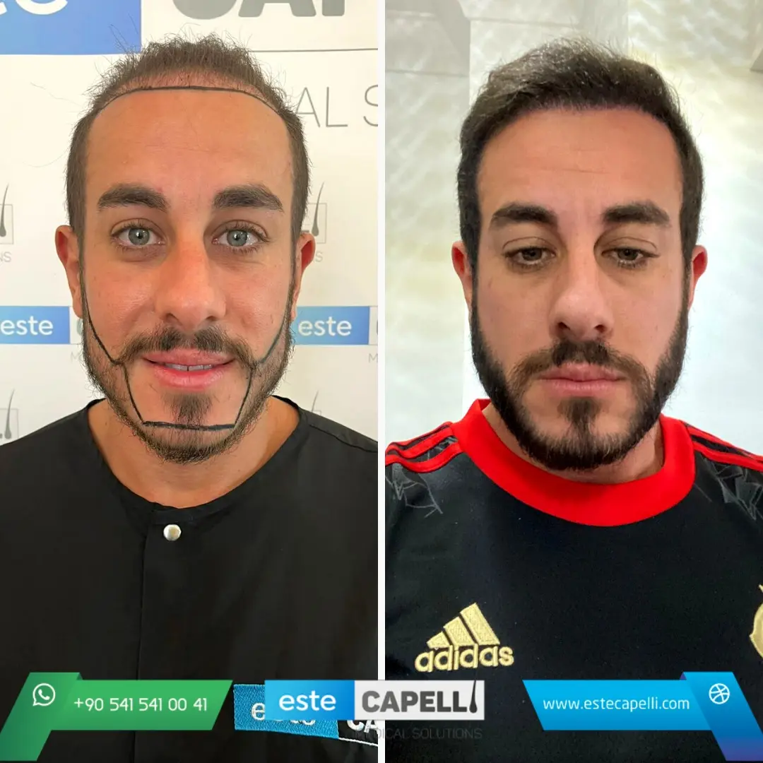 Before and after result