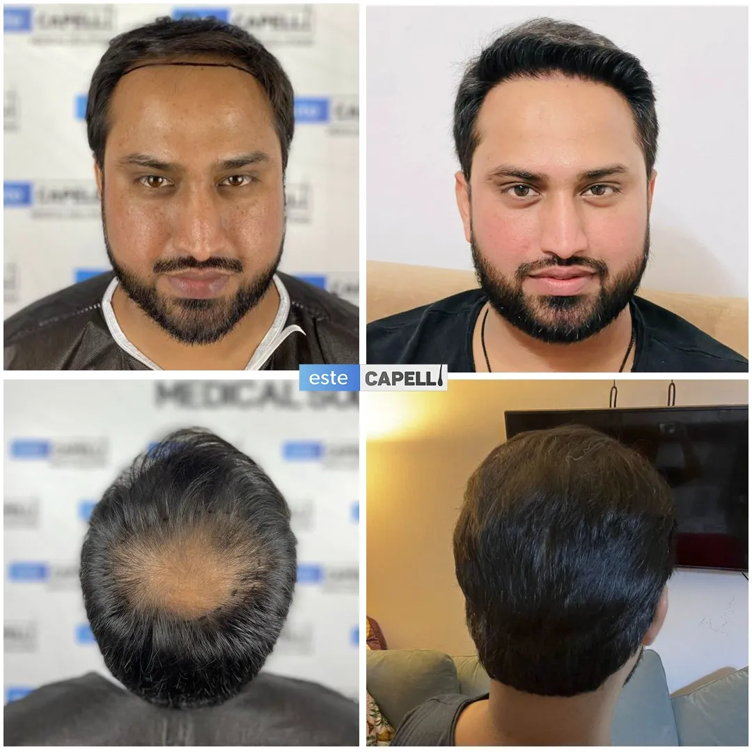 Before and after result