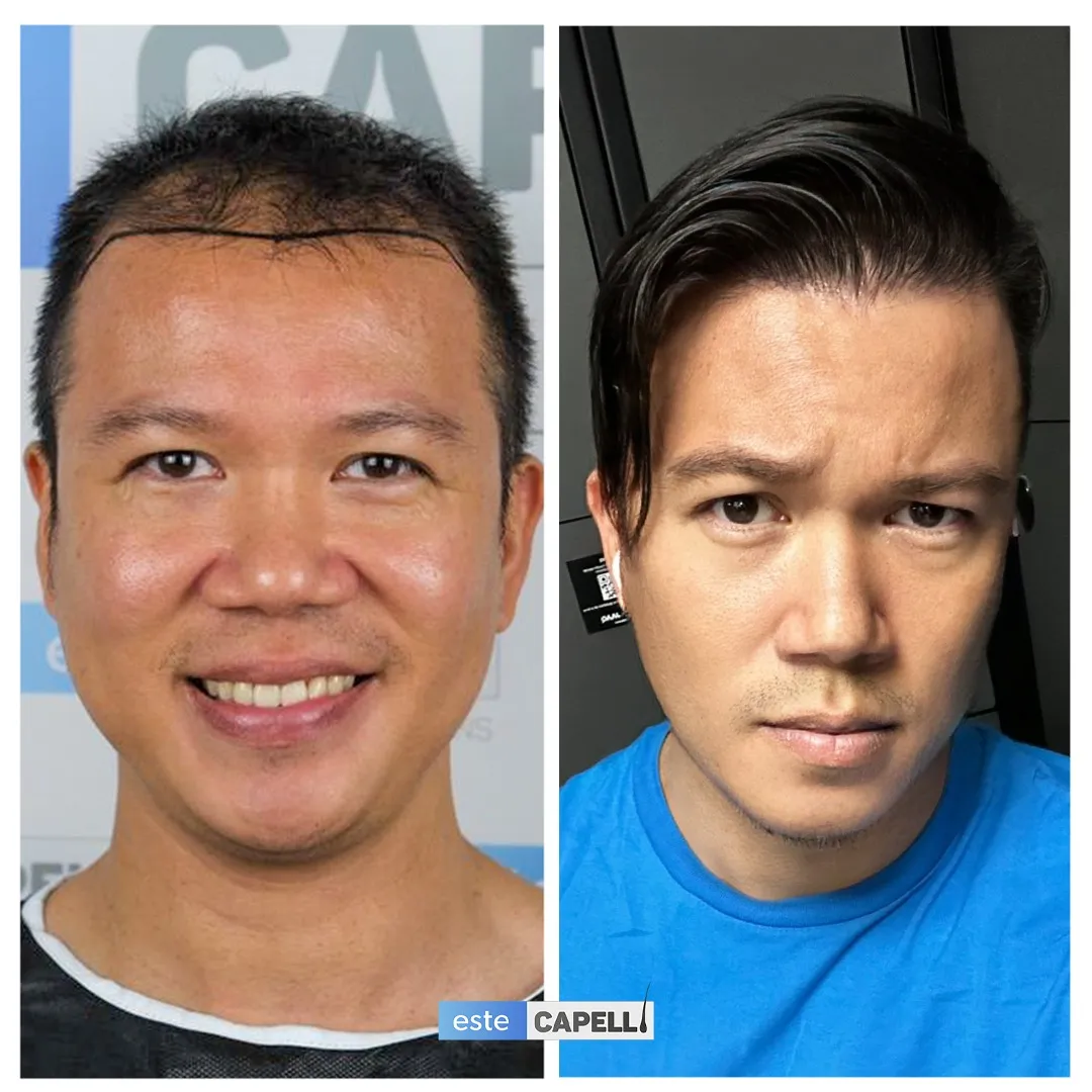 Before and after result