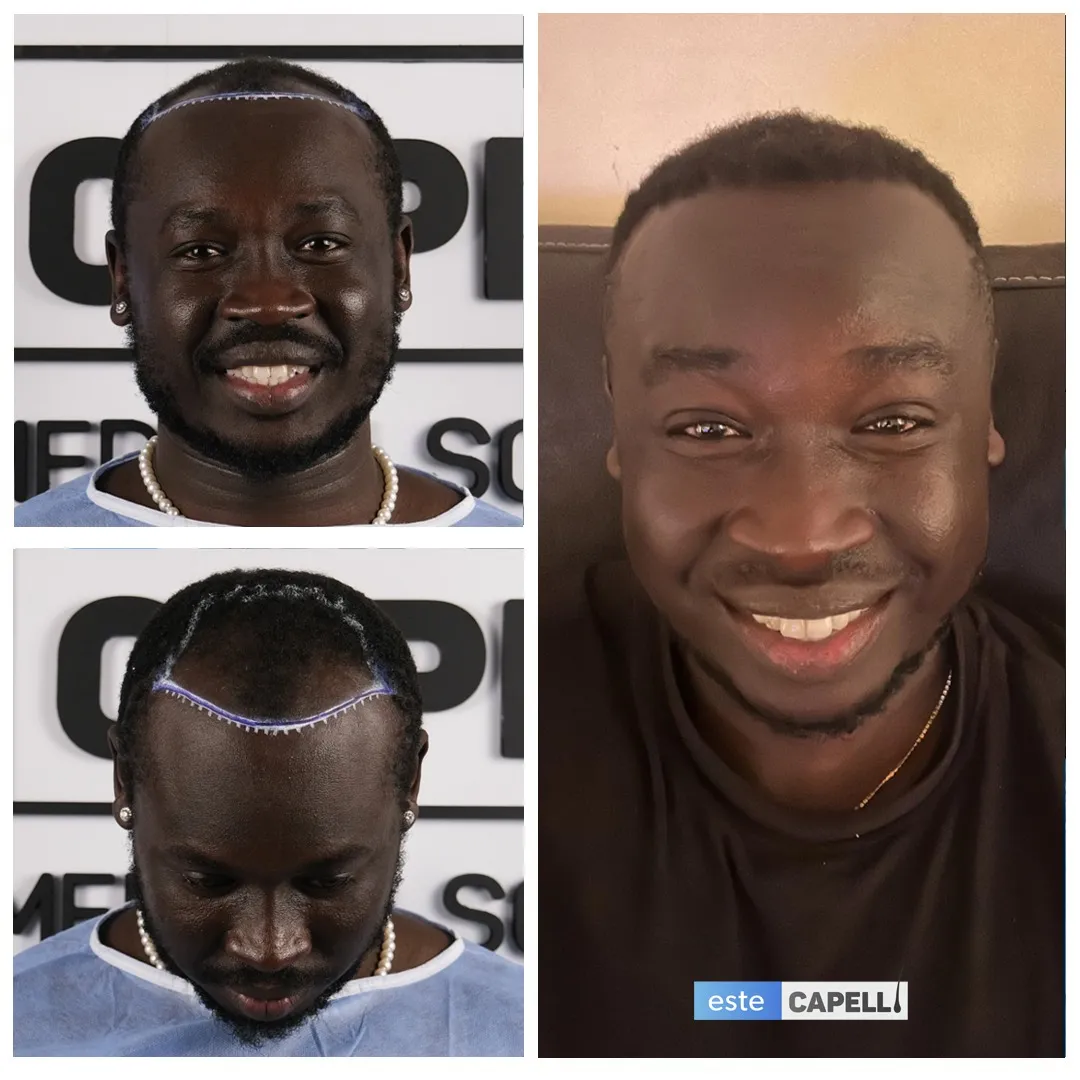 Before and after result