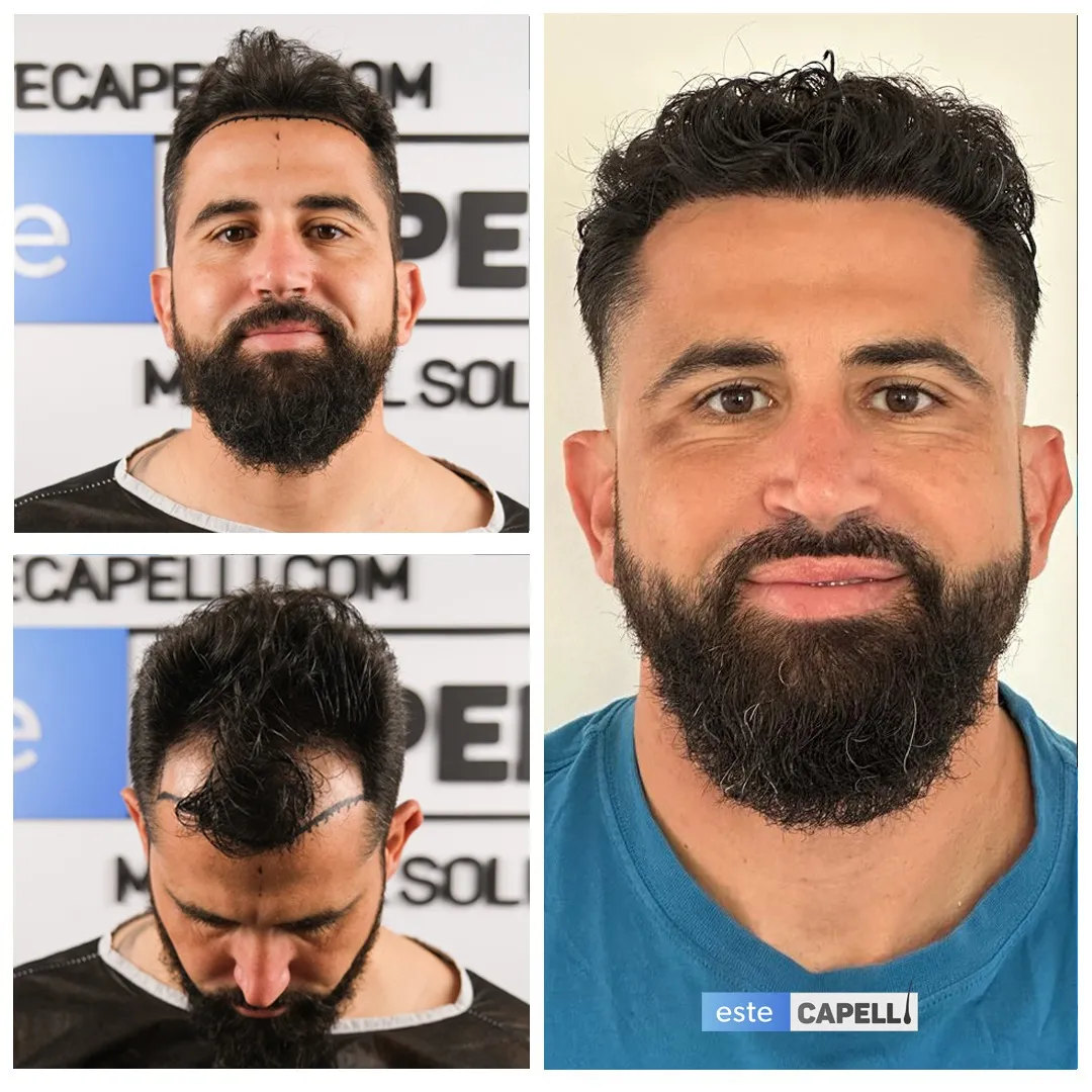 Before and after result