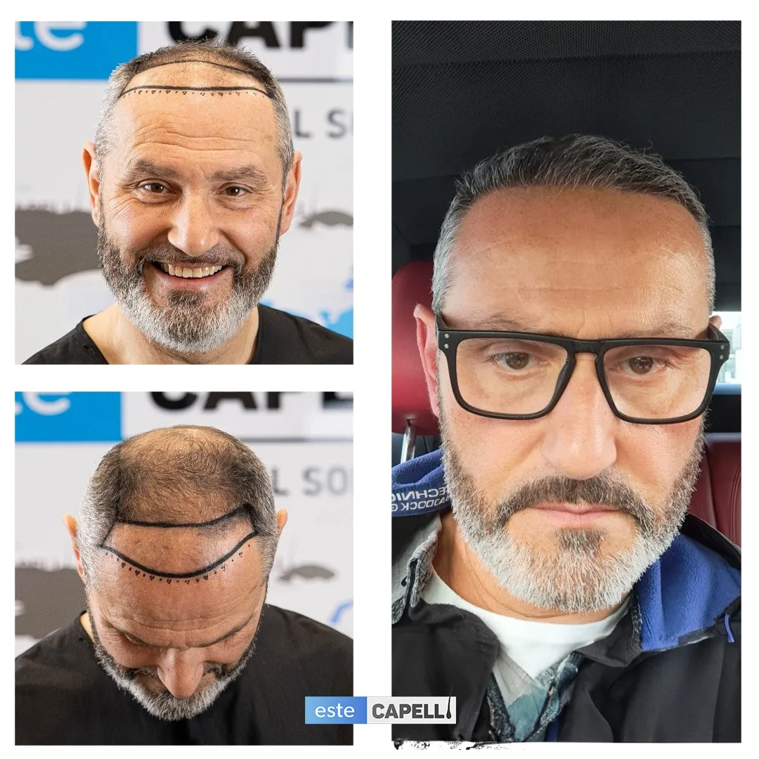Before and after result