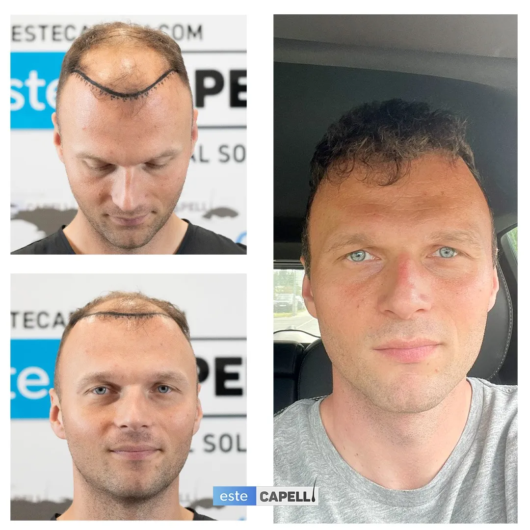 Before and after result