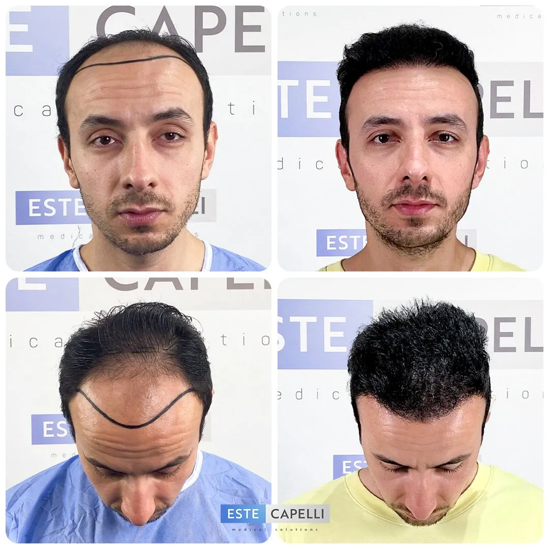 Before and after result