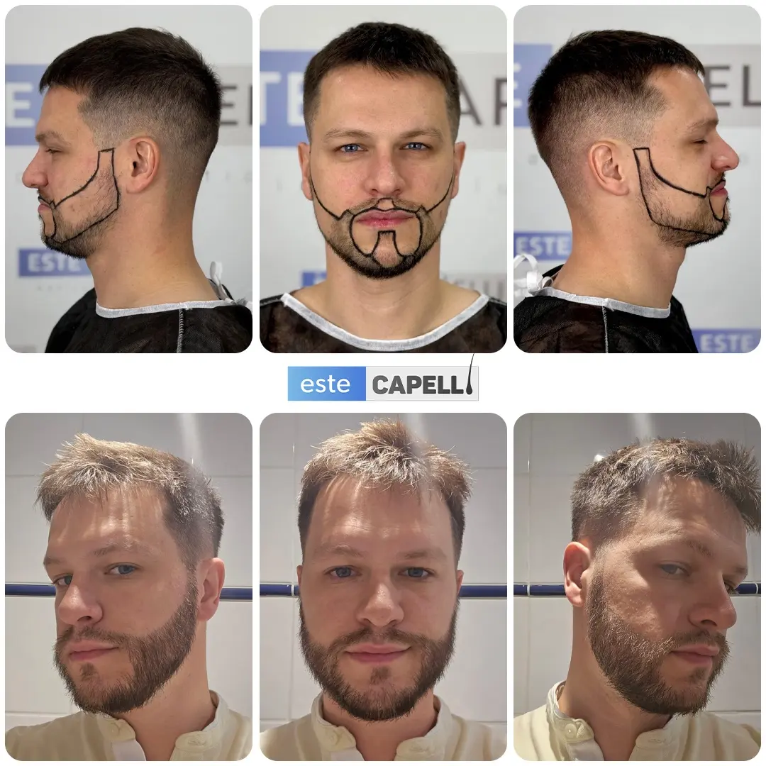 Before and after result
